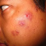 Shingles Symptoms - How to Treat the Condition Quickly?