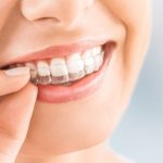 Say goodbye to misaligned teeth with clear aligners